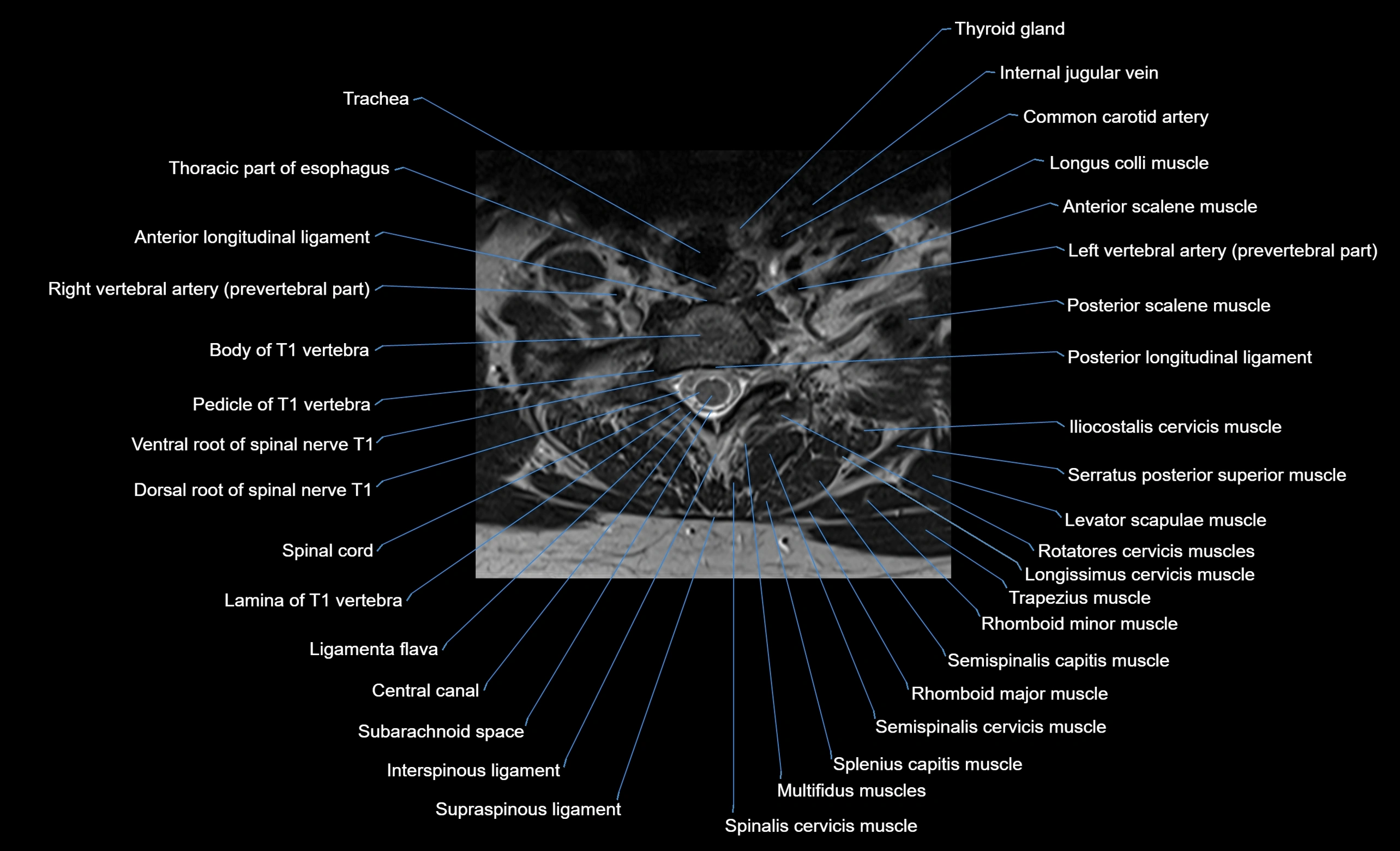 cervical spine cross sectional MRI anatomy  3T MRI axial  image-img-00001-00041.webp